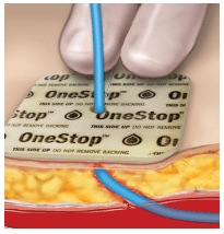 OneStop Vascular Pre-Slit Technology